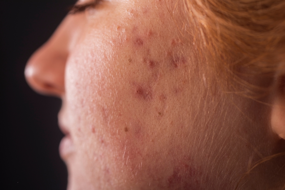 Acne behandelen in Hoorn