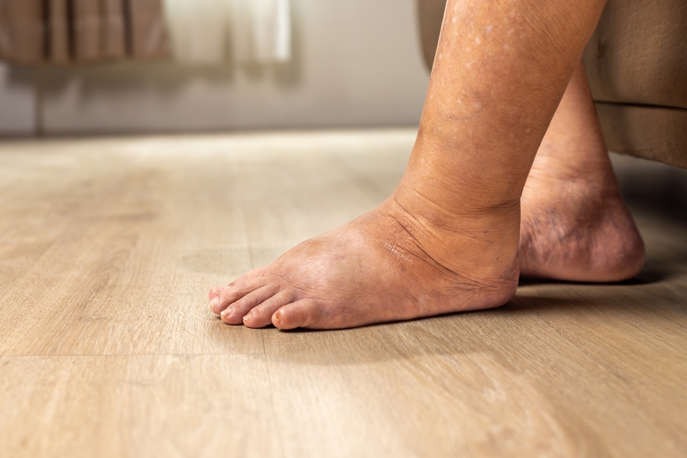 Oedeem behandelen in Hoorn