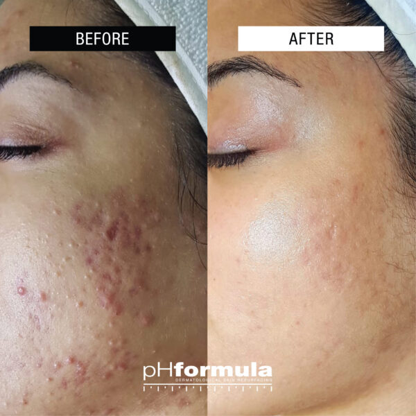 Acnetherapie behandeling in Hoorn