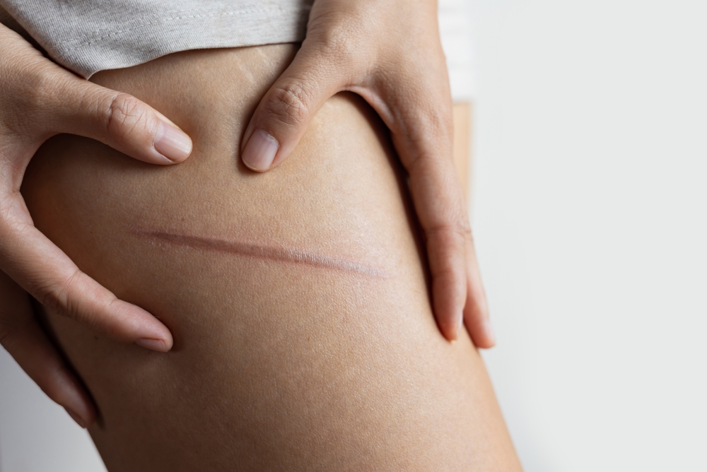 Littekens behandelen