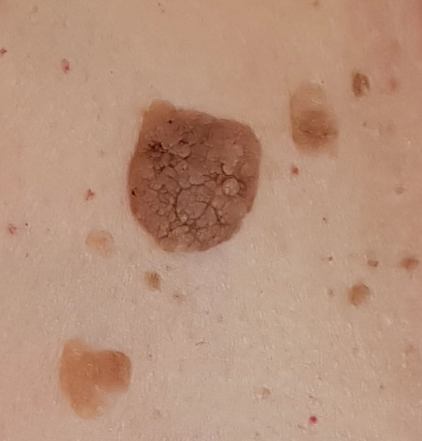 Ouderdomswratten behandelen in Hoorn