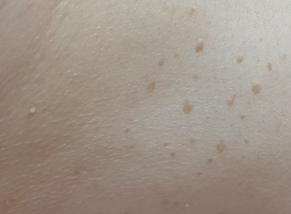 Bindweefselbultjes behandelen in Hoorn