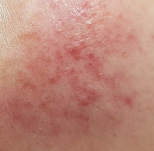 Chronische roodheid behandelen in Hoorn