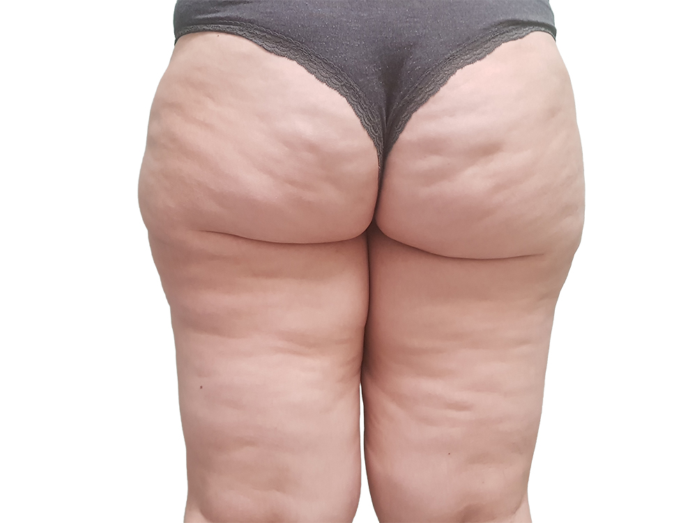 Lipoedeem behandelen in Hoorn